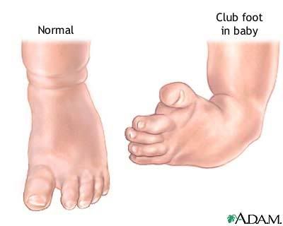 clubfoot surgery