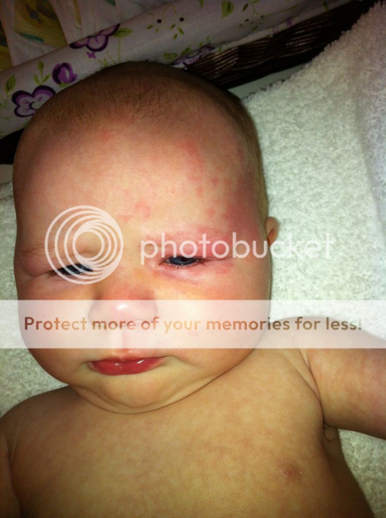 rash-reddness-around-eyes-after-crying-pic-babycenter